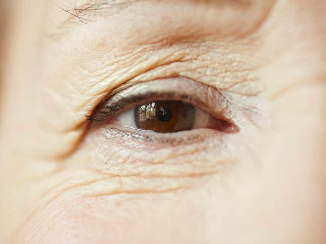 rugas embaixo dos olhos