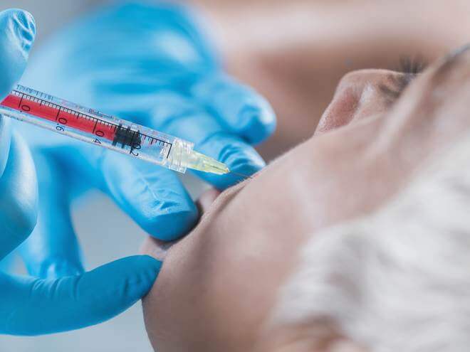 Como acabar com o sulco nasolabial